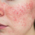 Rosacea Bundle