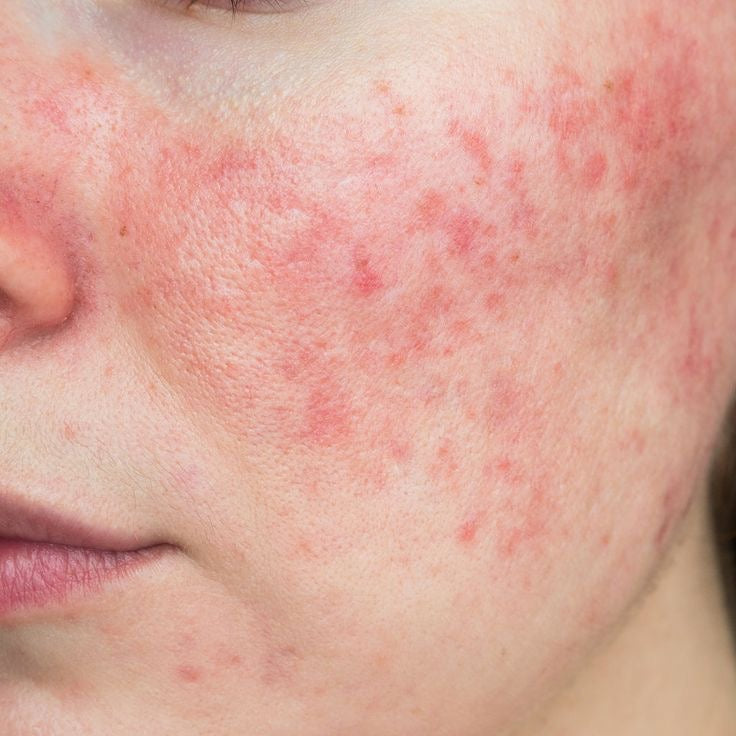 Rosacea Bundle