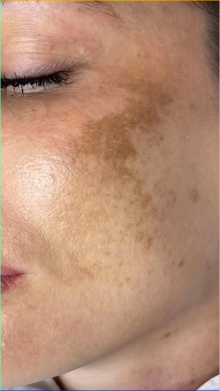 Melasma Bundle
