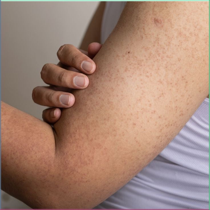 Keratosis Pilaris Bundle