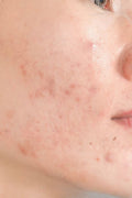 Clear Skin Bundle