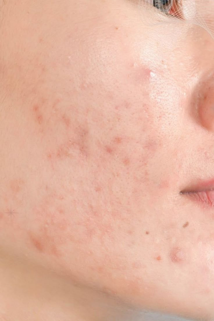 Clear Skin Bundle